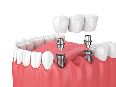 dental implant restorations